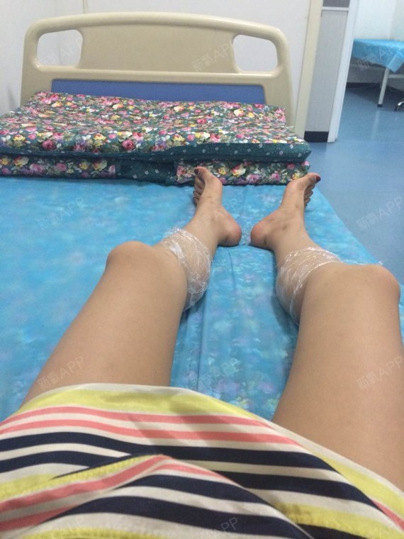 《和毽子肉61说拜拜》我提天生小腿肌肉发达,所以注射_圈子-新氧