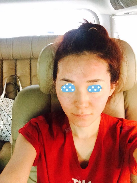 7.15去首尔的bellage做了PRP,水光针和florace