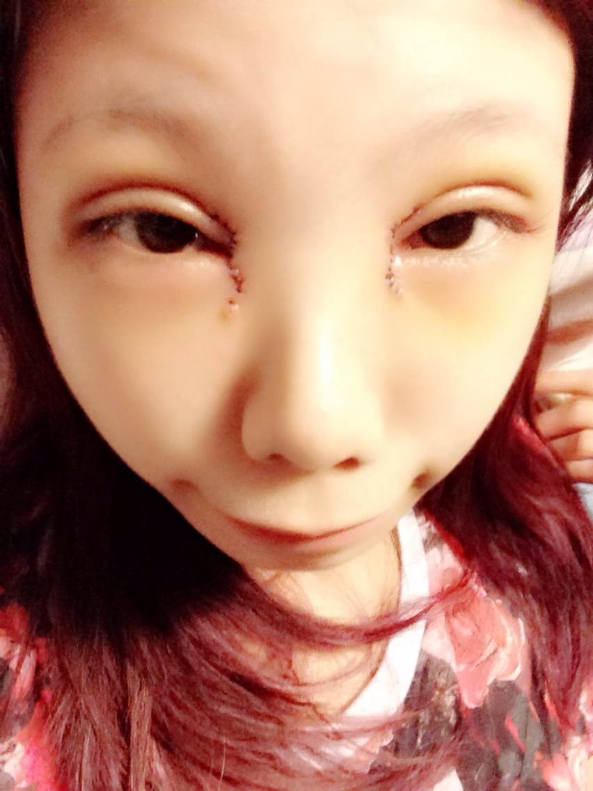 今天早上醒来感觉眼周没那麼肿了至少用力睁开眼睛的阻力减小了双