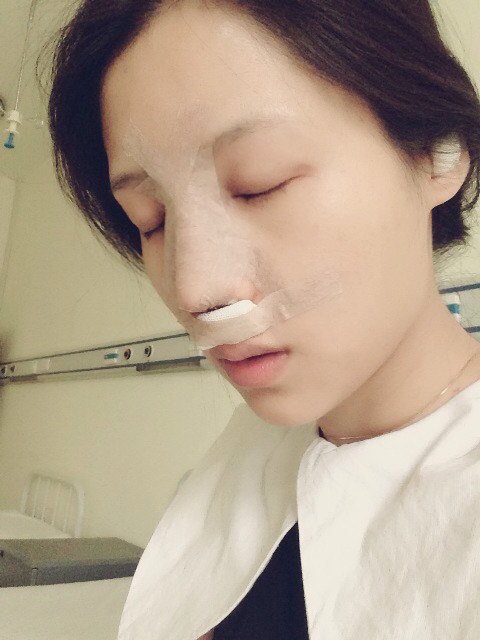 耳软骨硅胶隆鼻