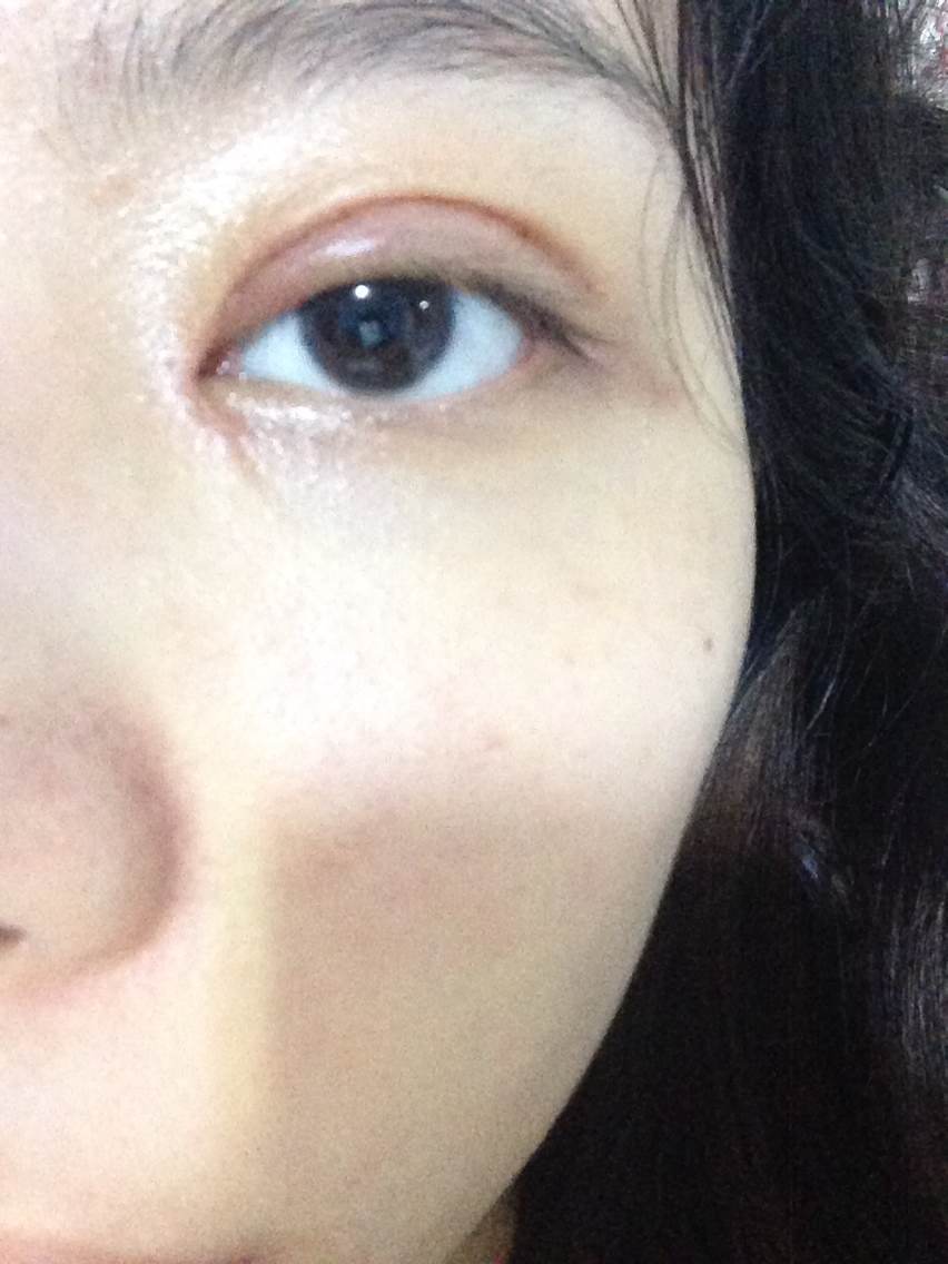 今天已经第十一天了,我的内眼角居然有个很大的褶,是不是做失败了阿?