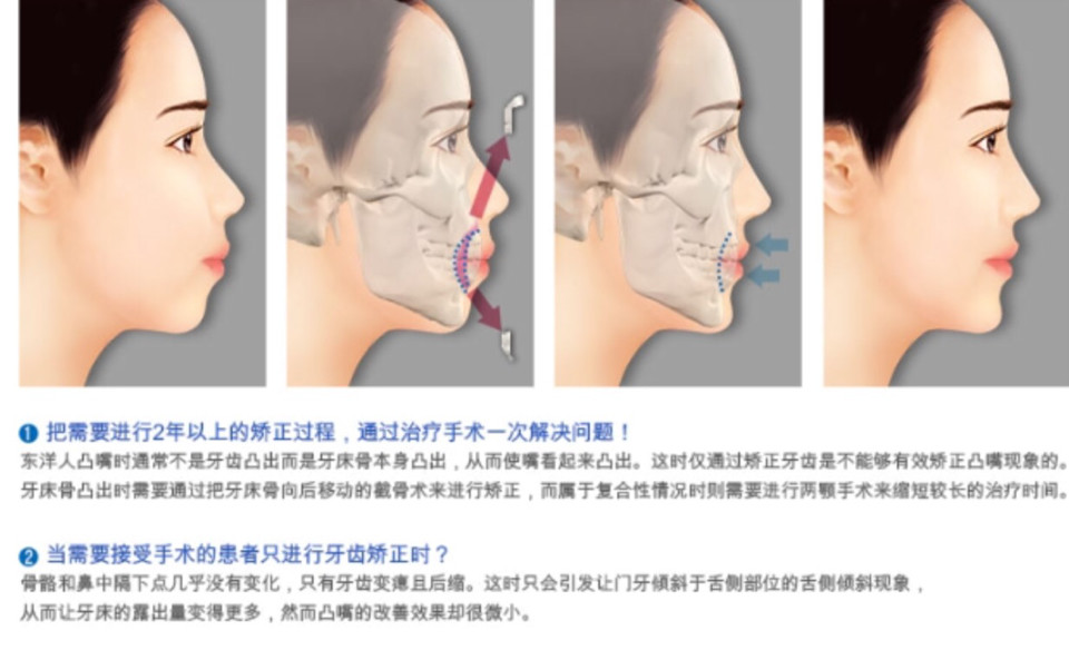 有谁关注过或者做过这个手术"突嘴手术",讨论一下.