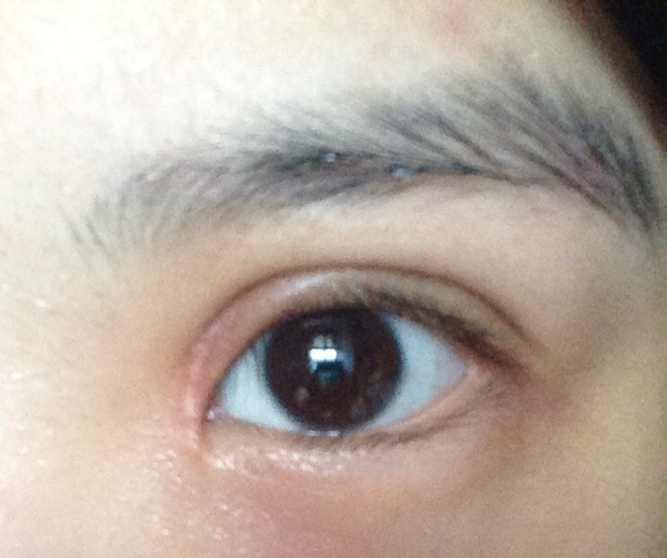 第53天～我真没有感觉割得不好还是什么,就是眼头增生…眼头增生是大