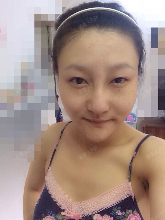 【美来之安免费手术】不再做鱼泡眼女生.非常