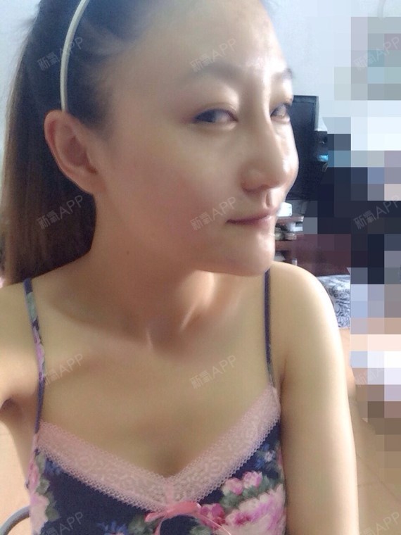 【美来之安免费手术】不再做鱼泡眼女生.非常