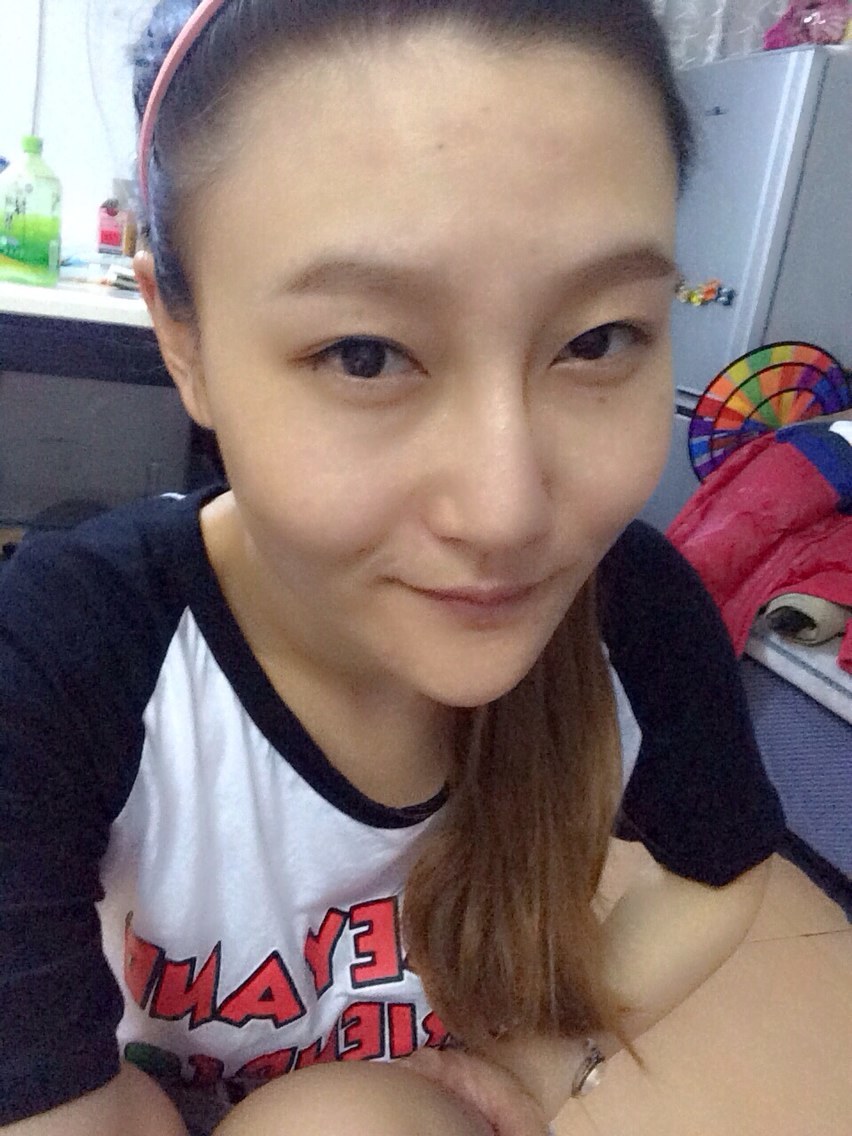 【美来之安免费手术】不再做鱼泡眼女生.非常感谢美来