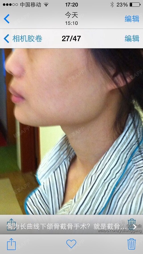 下颌骨美容手术术后半年今日复查效果震撼,我们满意,求美