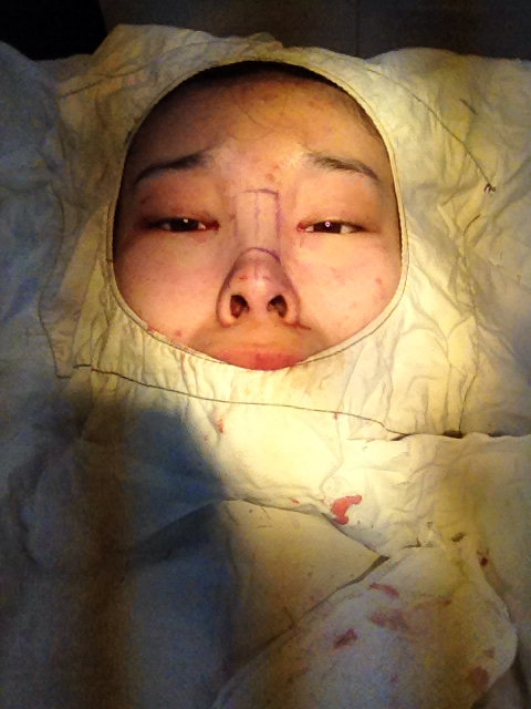 总觉得鼻孔有点歪!不知道是不是缝针的一侧鼻孔肿的比较严重的关系!