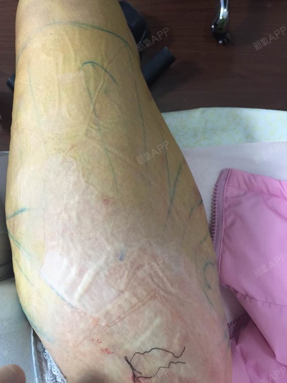 今天纱布了,腿瘦了不少.