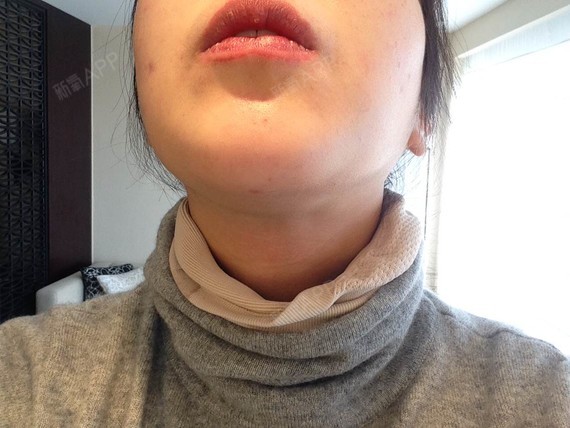 在韩国做的双下巴吸脂,已经两周,开口拆线只有