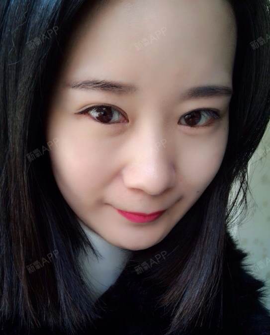 双眼皮手术82天_圈子-新氧美容整形