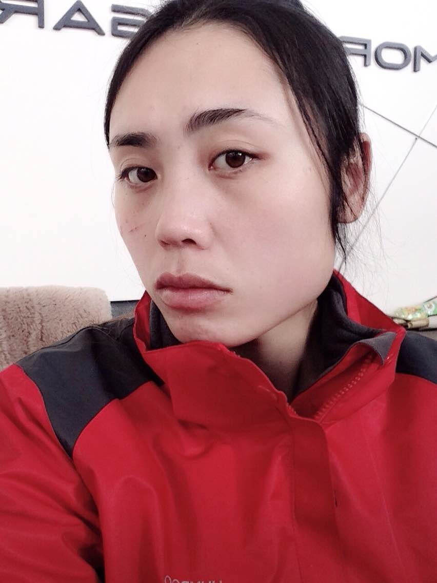 这两天觉得咬肌变得特别软,右脸吃东西时一鼓一鼓的,百度下说是血肿