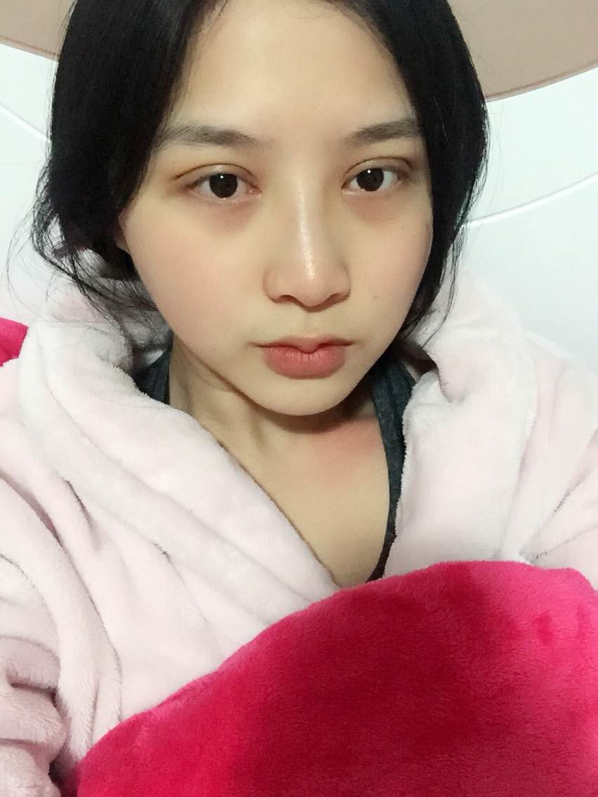 做了韩式三点,加抽脂,第一天的照片!_圈子-新氧美容