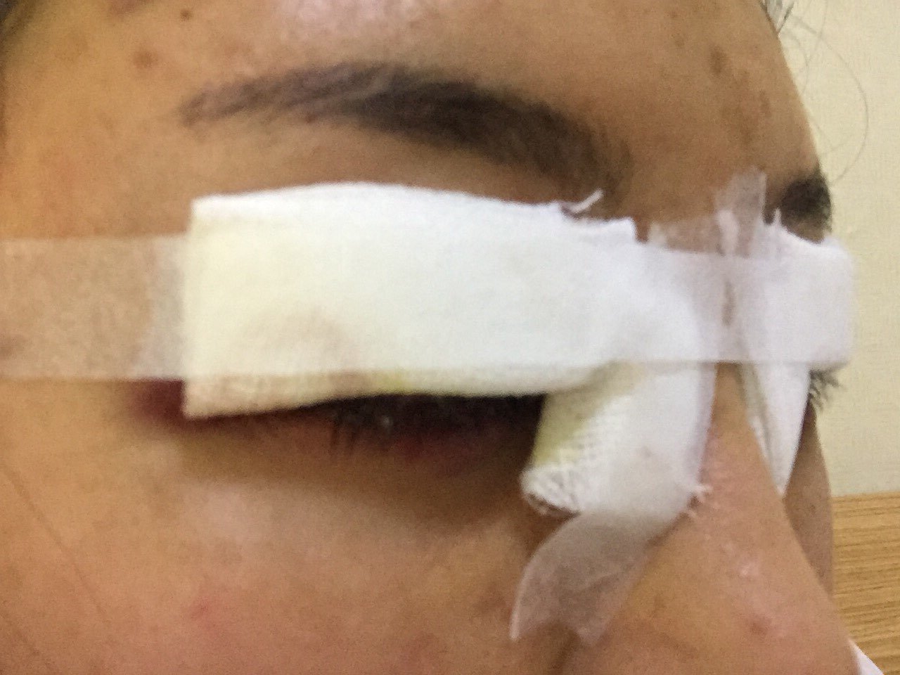 刚做完第一天,满满的期待感～等明天过来拆纱布就能看见效果了.