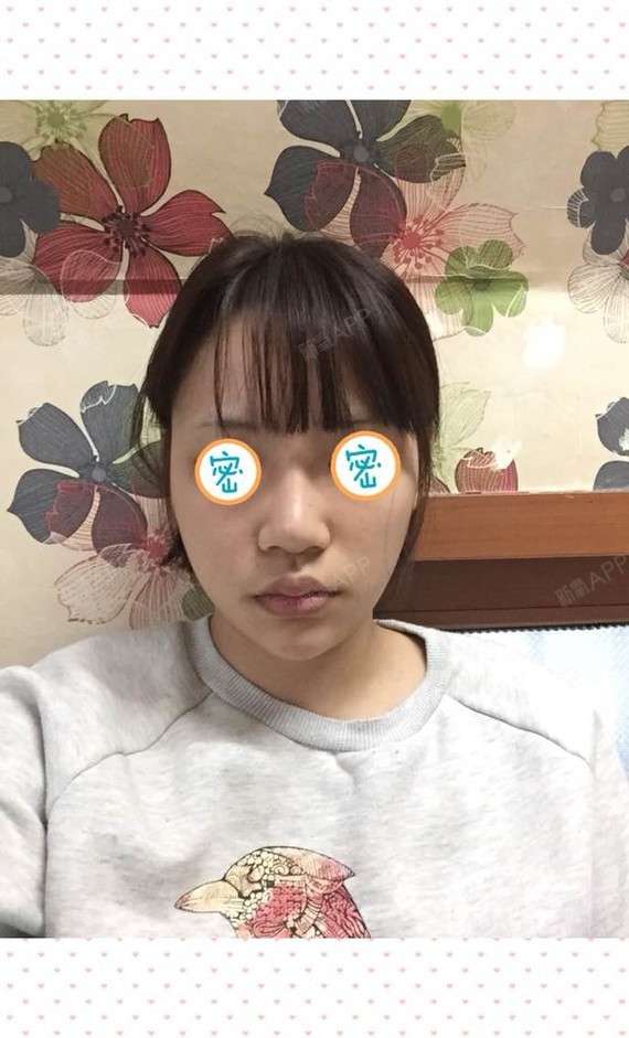 太厚以前没打下巴的时候自我感觉有点往外凸嘴