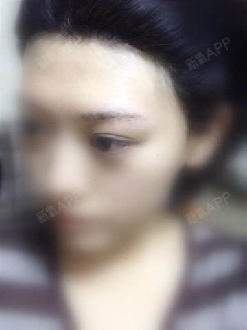 窄脑门.激光脱发际线