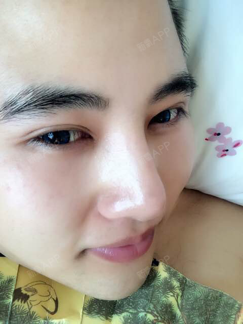 千面妖狐假体植入垫下巴第100天美丽日记-新氧