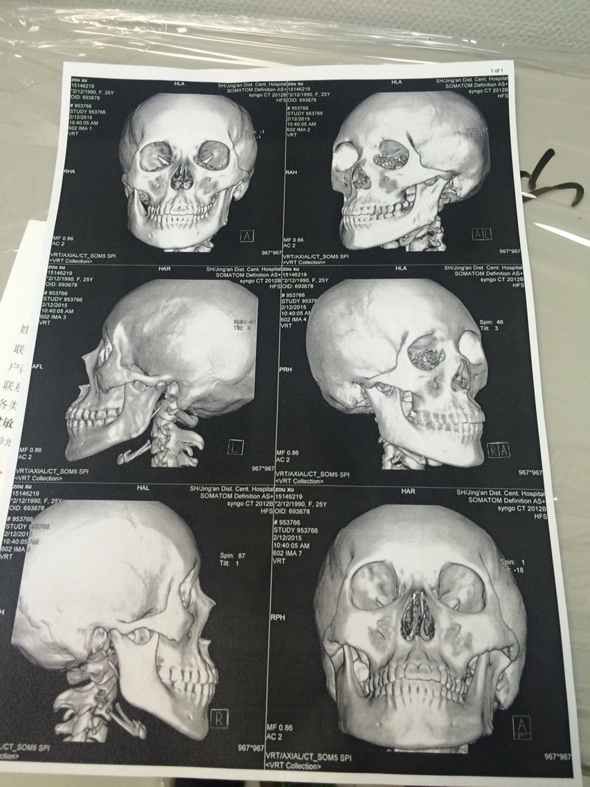大小脸,骨头都是畸形的,求推荐在上海的医生