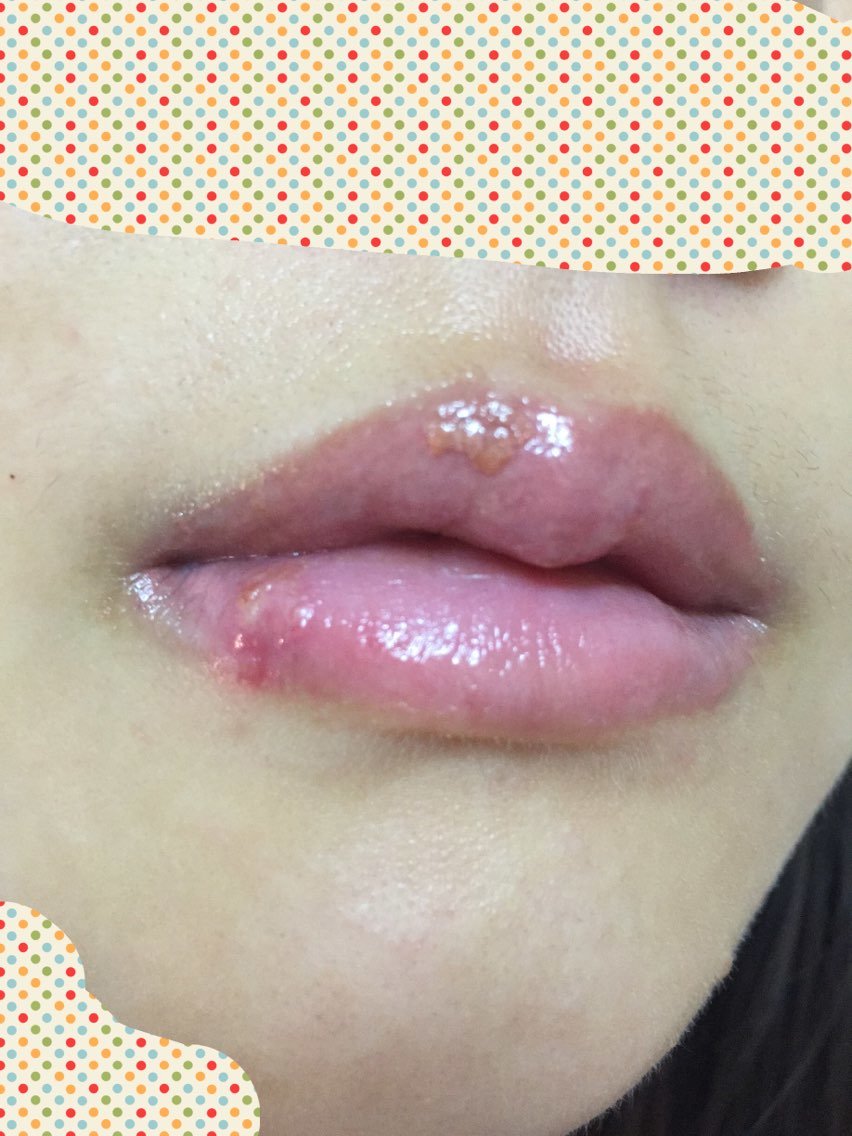 和嘴角的一点结痂未脱落了,但是今天睡醒了不知道为什么下嘴唇突然起