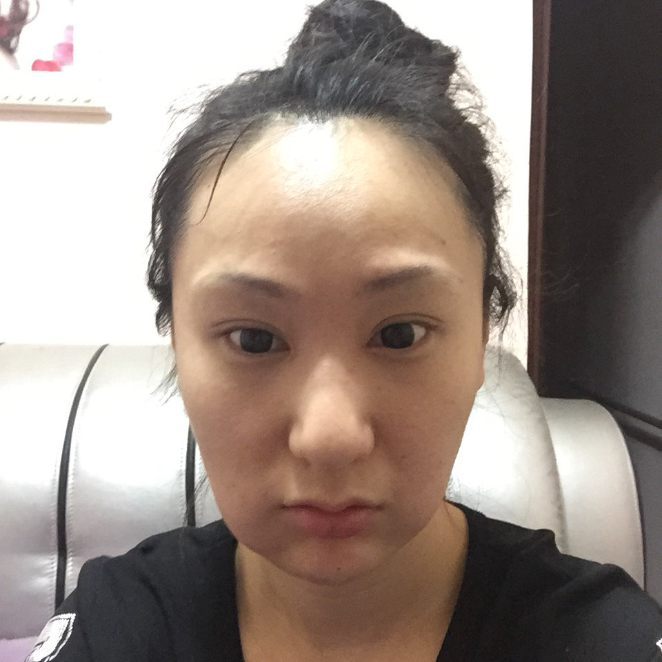我真心醉了第一次打ddk的溶脂针真的没有那么肿结果这次好肿晚上八点