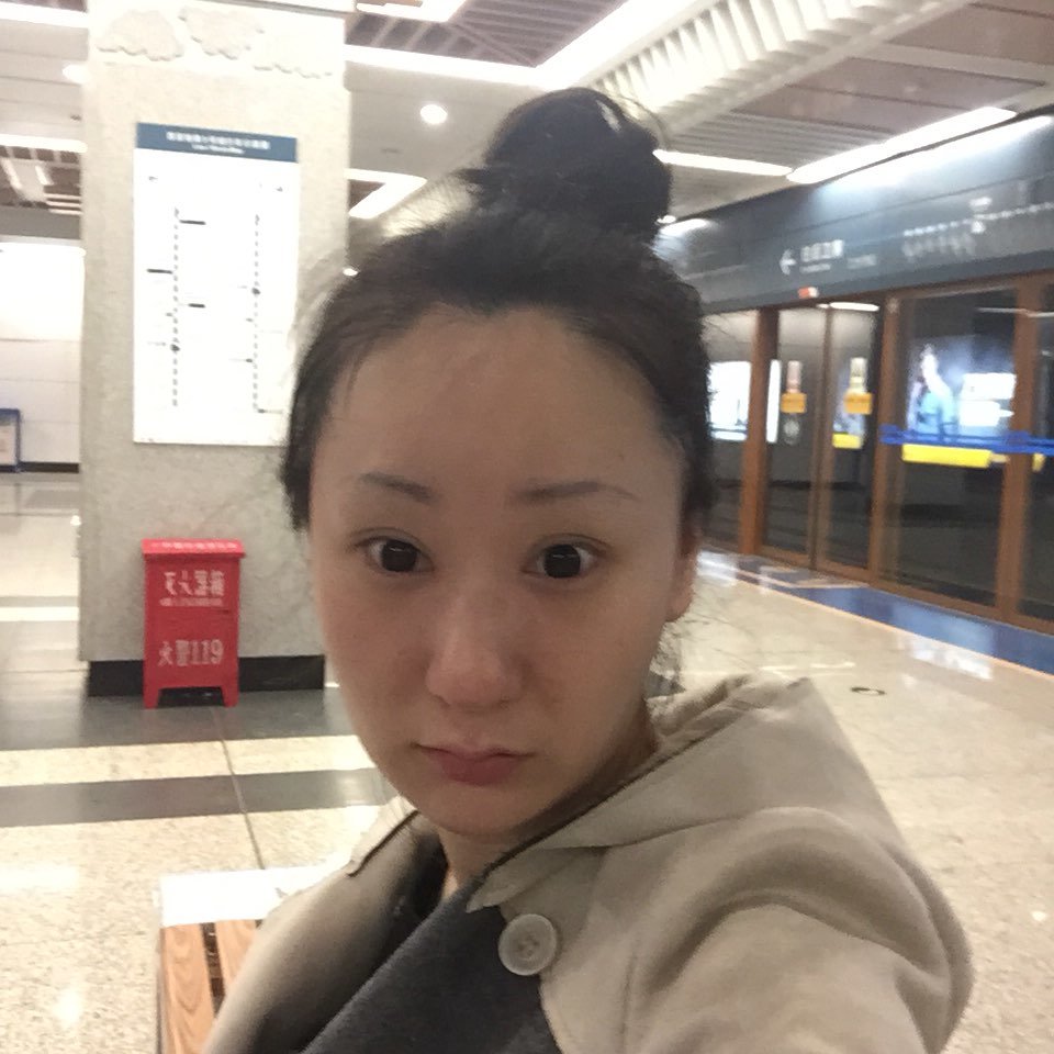 我真心醉了第一次打ddk的溶脂针真的没有那么肿结果这次好肿晚上八点