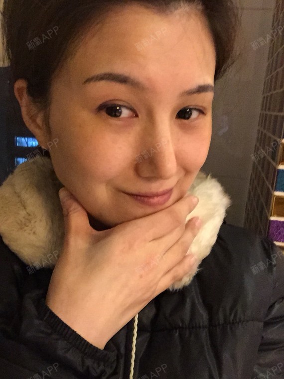 linda_gao宽鼻矫正第158天美丽日记-新氧美容