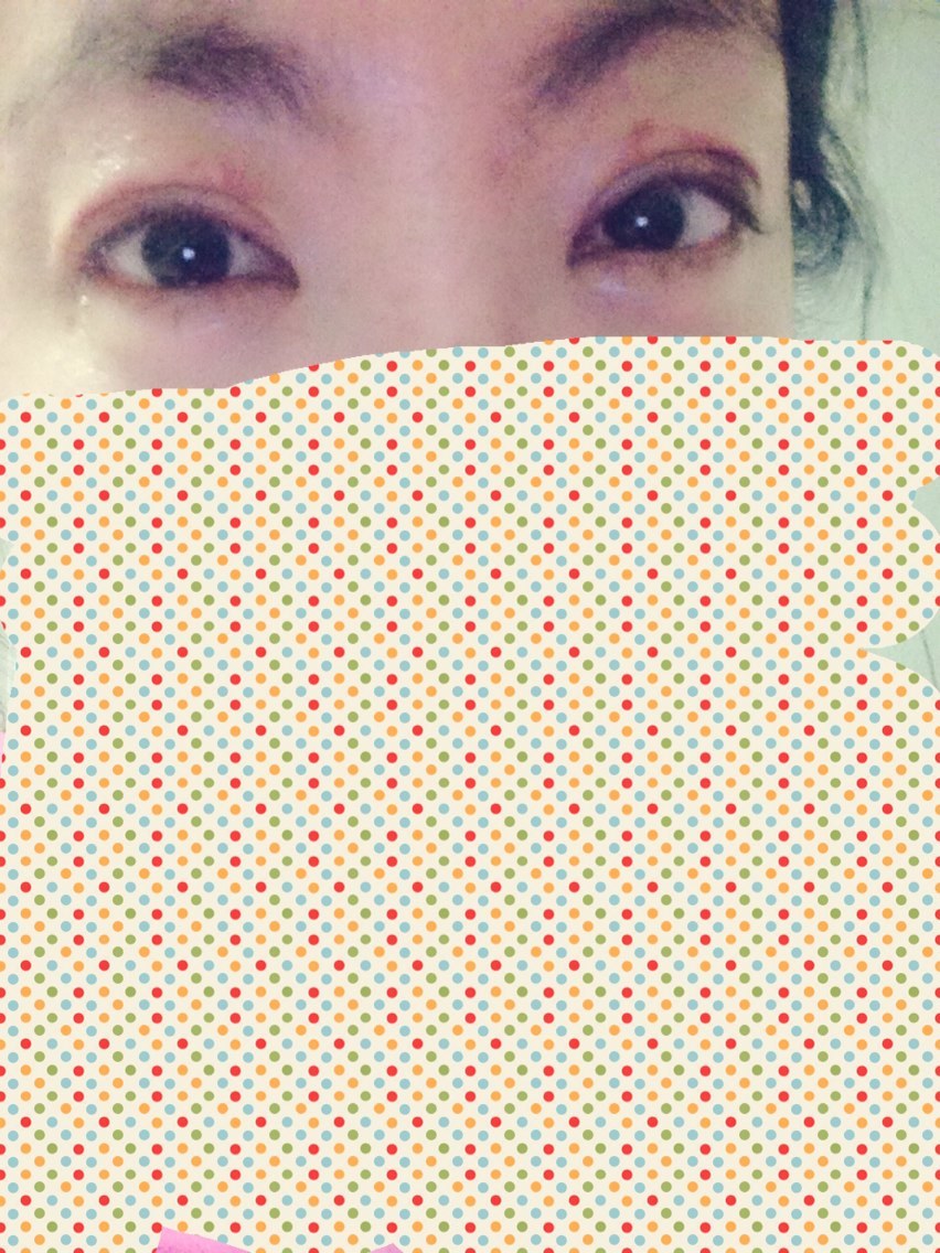 来来来,更新下术后12天的恢复情况
