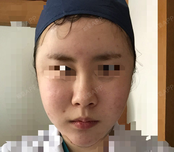 今天做了面颊抽脂加自体脂肪填充太阳穴,额头