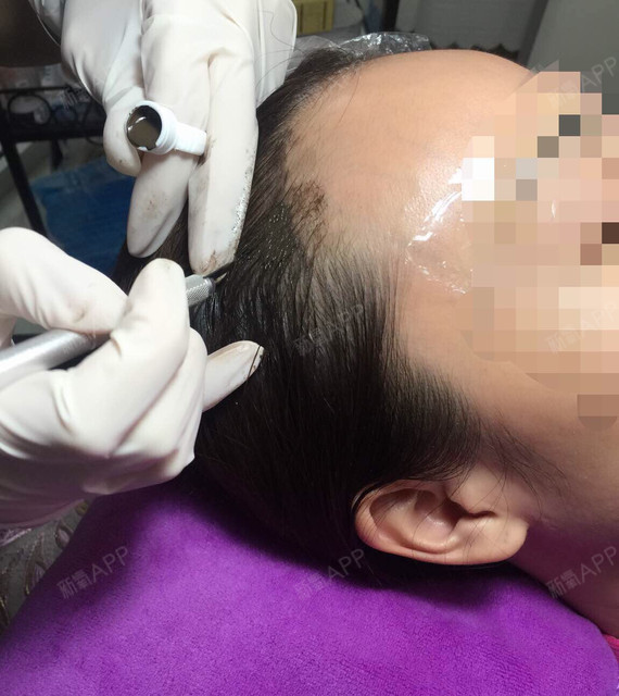 秃头?m字额头?小问题,不用毛发种植那么痛苦