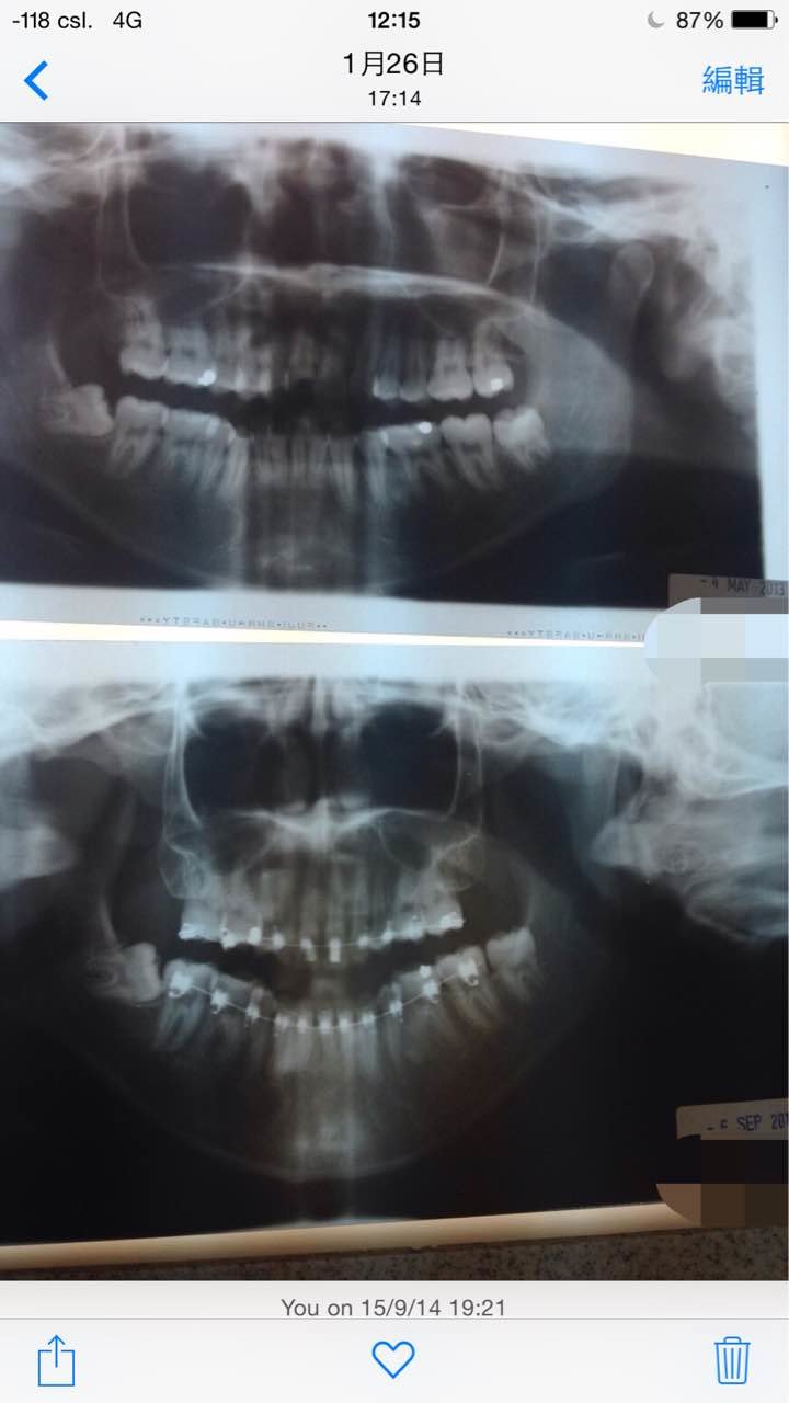 有ct图**接受了一年半牙齿矫正脸型的明显改善.纯分享,给点意见