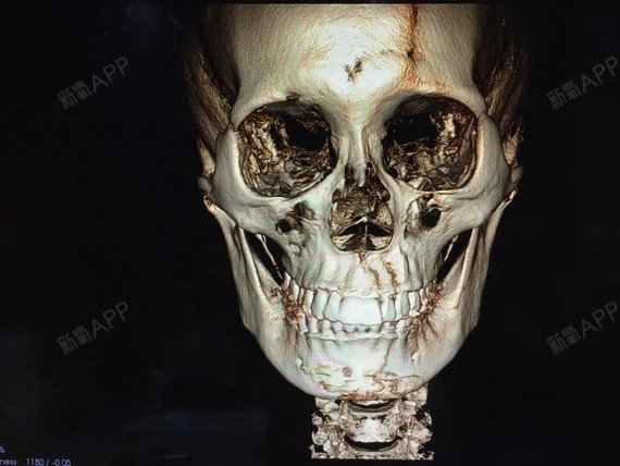 今天还在犹豫脸骨的问题,大家来帮我看看吧,到底颧弓和下颌角需不需要