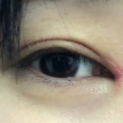 双眼皮恢复的还可以,眼角开始瘢痕增生了.