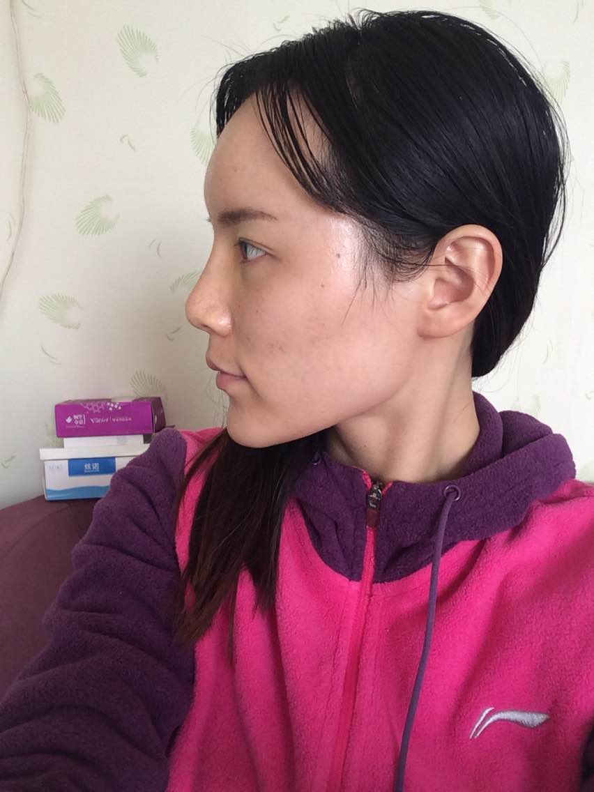 鼻子山根一直居高不下,而且感觉假体很明显不自然,发给朋友看竟然有说