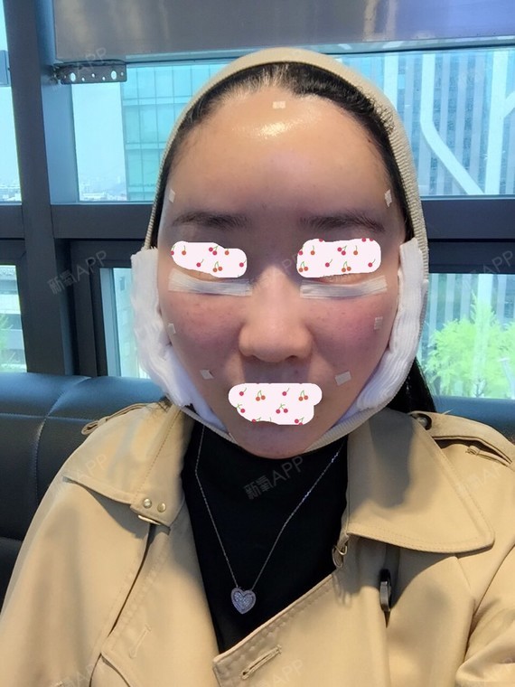 julia0103自体脂肪填充额头第78天美丽日记-新