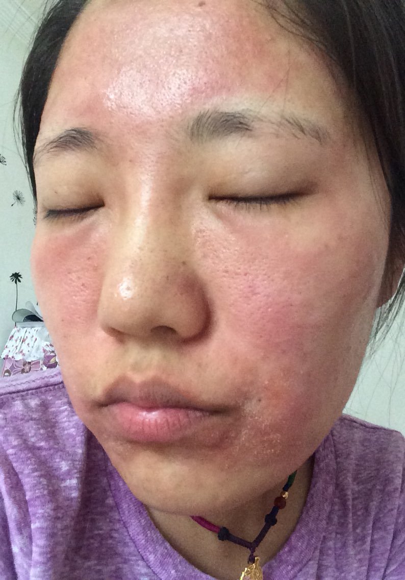 打完水光第二天严重过敏,太恐怖了.脸像被烧了一样!