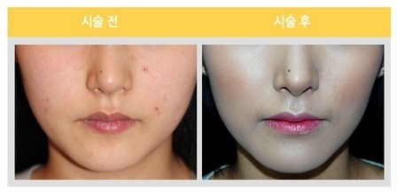 818韩国超流行的氧气护肤法, 皮肤再生,美白,祛痘,保湿,提升