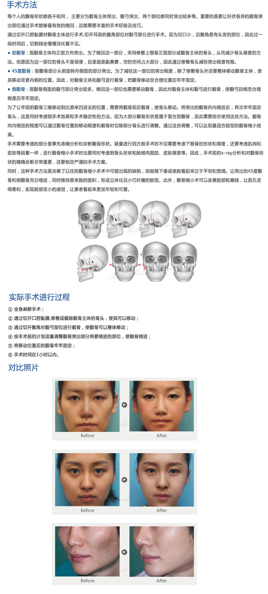 v-line瓜子脸手术 | 去颊脂垫瘦脸 | 注射肉毒素痩脸(瘦脸针)