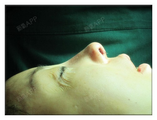 隆鼻修复+综合鼻整形+假体隆下颏的心路历程