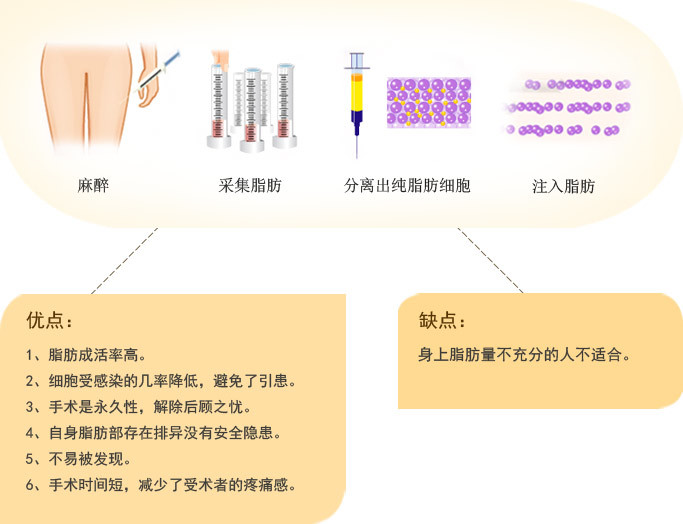 真实案例02.适合做自体脂肪丰胸的人群03.手术方法1.