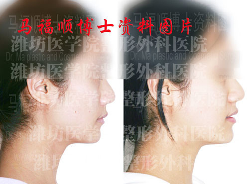 咬肌部分切除方脸整形术对比照片