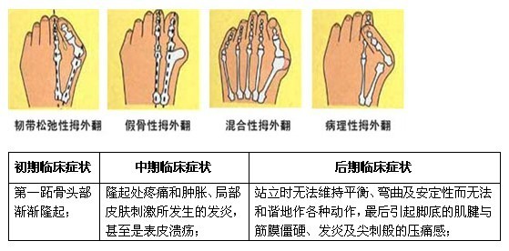 微创大脚骨根治术 20分钟还原美足