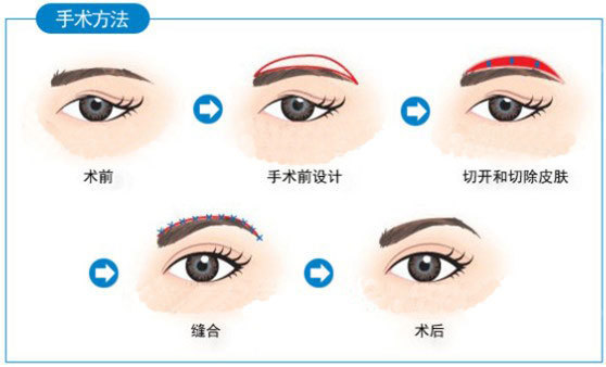 眉部整形的四大适应症拥有一对漂亮的眉毛,可以令五官增色不少。新年假期里,_圈子-新氧美容整形