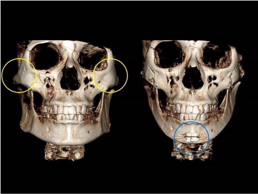 脸部轮廓手术的前后对比,骨头的变化(二)---颧骨缩小术和vline四方