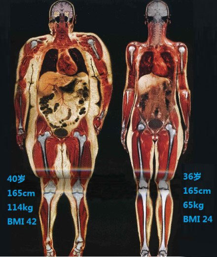 9 "啤酒肚"的脂肪都在哪里?