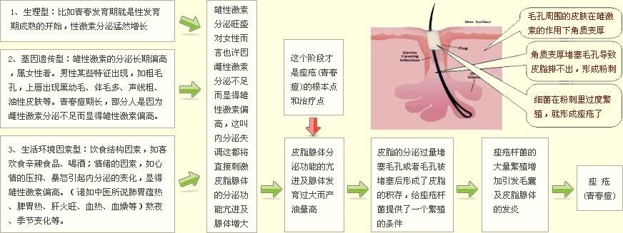 祛痘之前先了解一下痘痘形成的原因吧