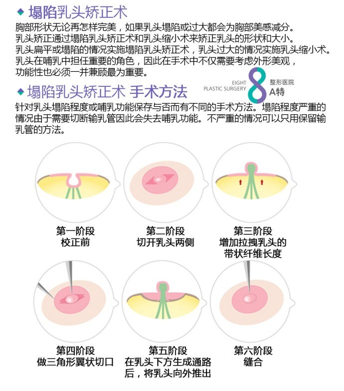 ∞8a特整形医院8∞【塌陷乳头矫正】胸部形状无论再