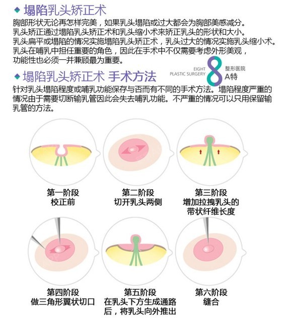 8  a特整形医院 8∞ 乳头矫正通过塌陷乳头矫正术和乳头缩小术来