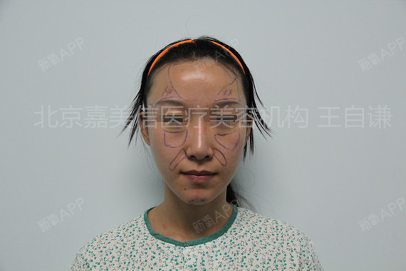 王自谦自体脂肪填充全脸第50天美丽日记-新氧