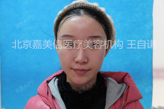 王自谦自体脂肪填充全脸第50天美丽日记-新氧