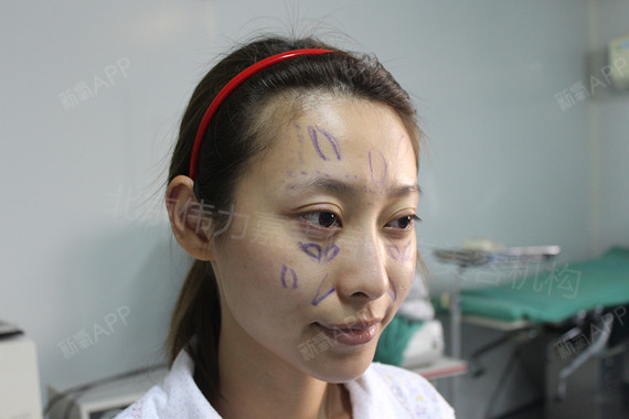 王自谦自体脂肪全脸填充第1天美丽日记-新氧美